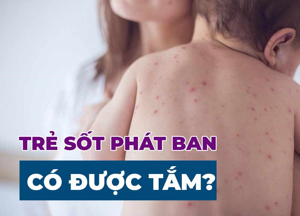 Bé Bị Sốt Phát Ban Có Tắm Được Không?