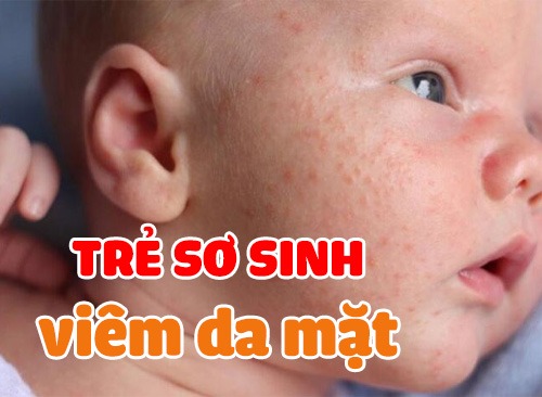 Trẻ Sơ Sinh Bị Viêm Da Ở Mặt - Cách Mẹ Chăm Sóc Hiệu Quả Tại Nhà