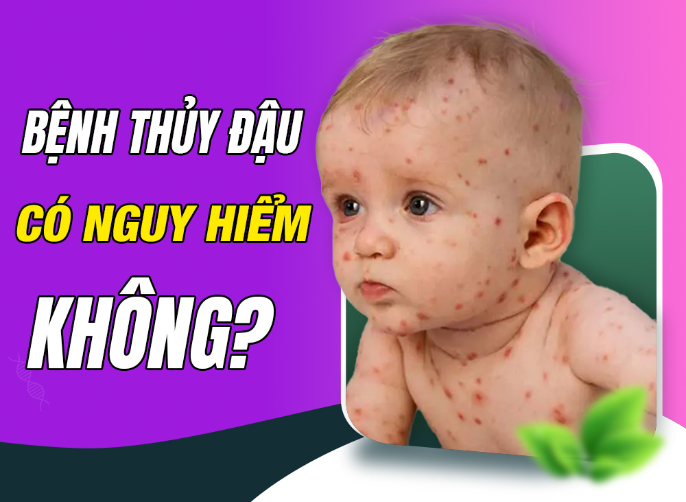 Bệnh Thủy Đậu Có Nguy Hiểm Không