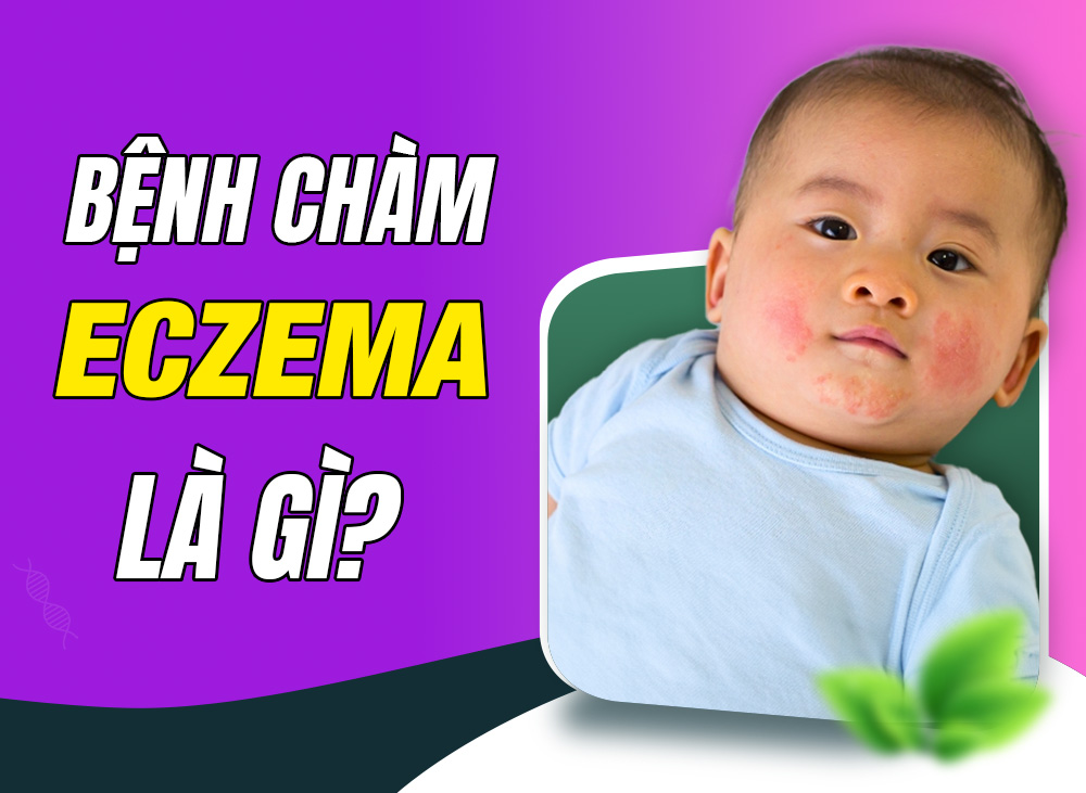 Bệnh Chàm Eczema Là Gì – Cách Nhận Biết Và Điều Trị Eczema