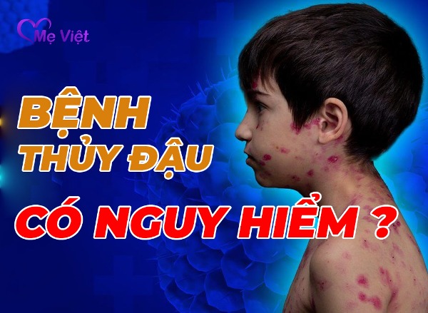 Bệnh Thủy Đậu Có Nguy Hiểm Không