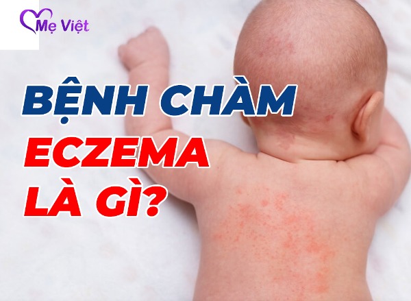 Bệnh Chàm Eczema Là Gì – Cách Nhận Biết Và Điều Trị Eczema