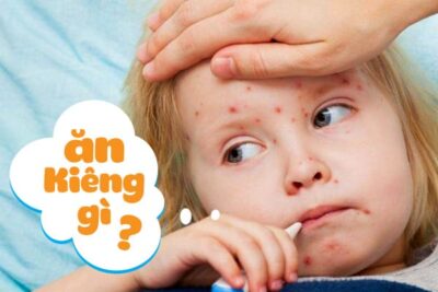Sốt Phát Ban Ở Trẻ Em Cần Kiêng Gì Để Nhanh Hết?