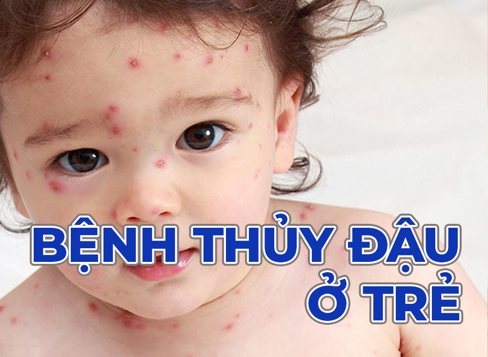 Bệnh Thủy Đậu Có Nguy Hiểm Không