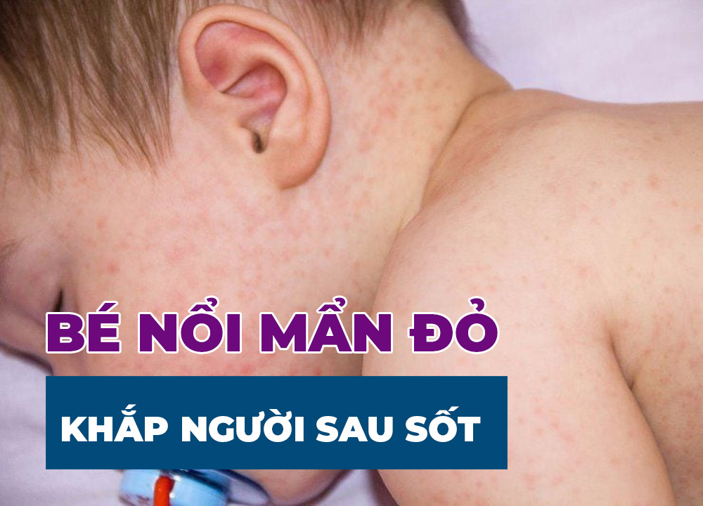Bé Nổi Mẩn Đỏ Khắp Người Sau Sốt Là Bệnh Gì? Cách Mẹ Chăm Sóc Tại Nhà