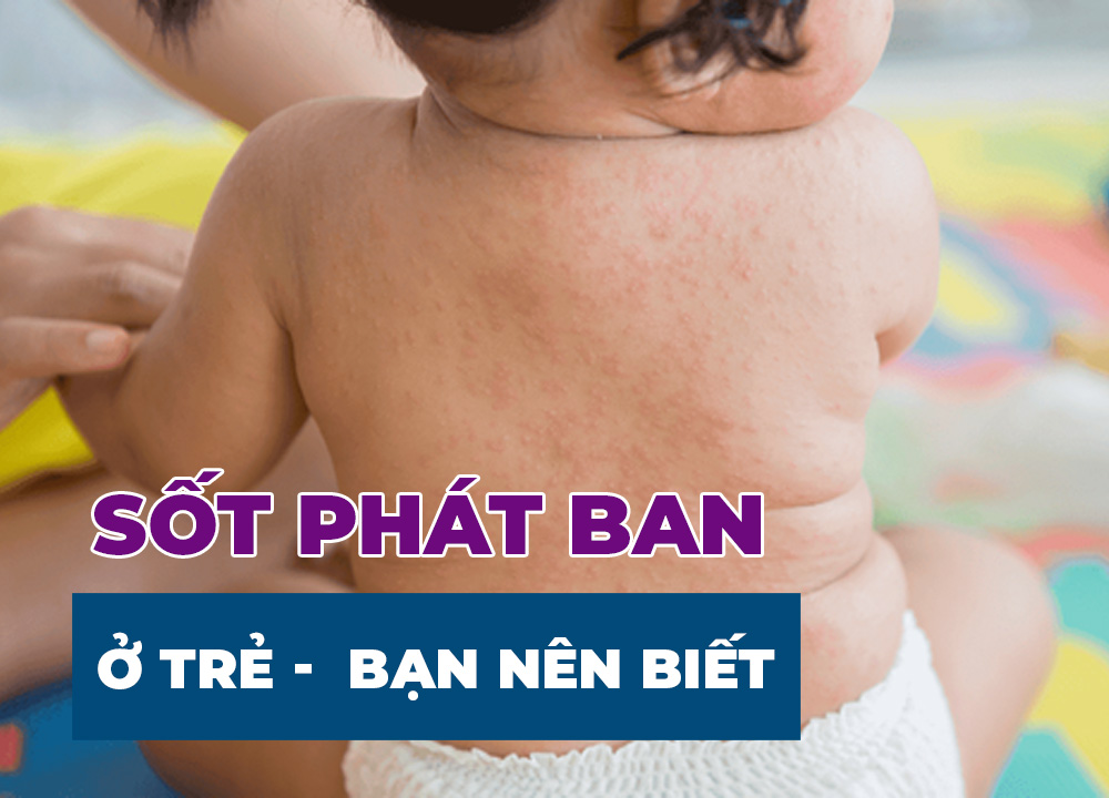 Sốt Phát Ban Ở Trẻ - Hiểu Đúng, Chăm Sóc Hiệu Quả